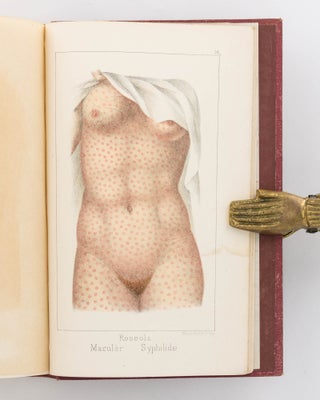Constitutional Syphilis. Being a Practical Illustration of the Disease in its Secondary and Tertiary Stages