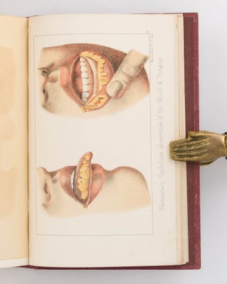 Constitutional Syphilis. Being a Practical Illustration of the Disease in its Secondary and Tertiary Stages