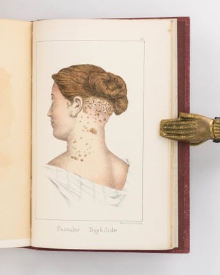 Constitutional Syphilis. Being a Practical Illustration of the Disease in its Secondary and Tertiary Stages