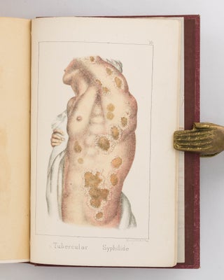 Constitutional Syphilis. Being a Practical Illustration of the Disease in its Secondary and Tertiary Stages