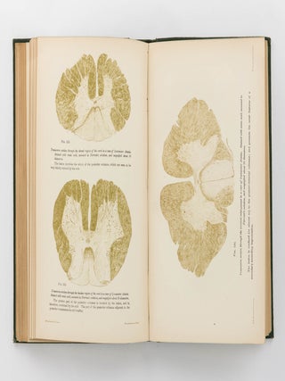 Diseases of the Spinal Cord