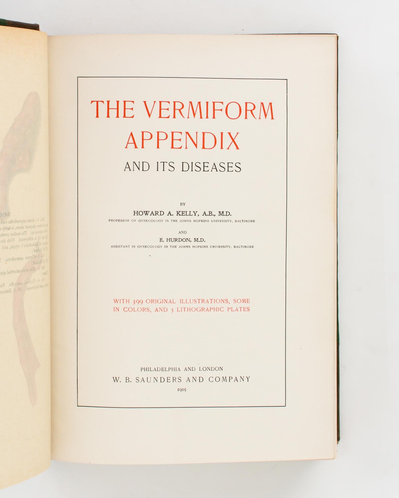 Vermform Appendix The Vermiform Appendix and its Diseases | Howard A. KELLY, E. HURDON ...